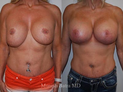 Complex Breast Before & After Gallery - Patient 110333 - Image 1