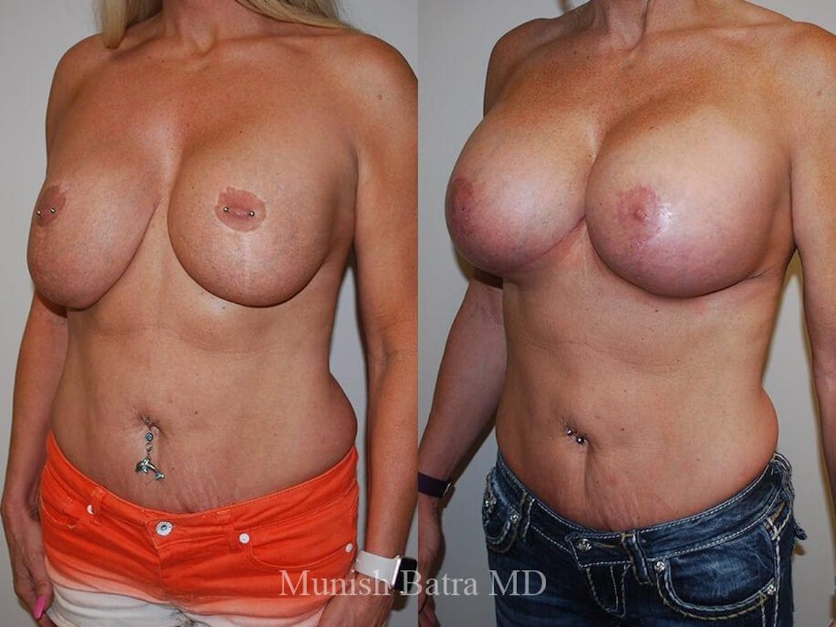 Complex Breast Before & After Gallery - Patient 110333 - Image 2