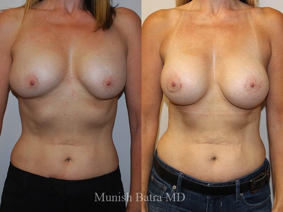 Complex Breast Before & After Gallery - Patient 329985 - Image 1