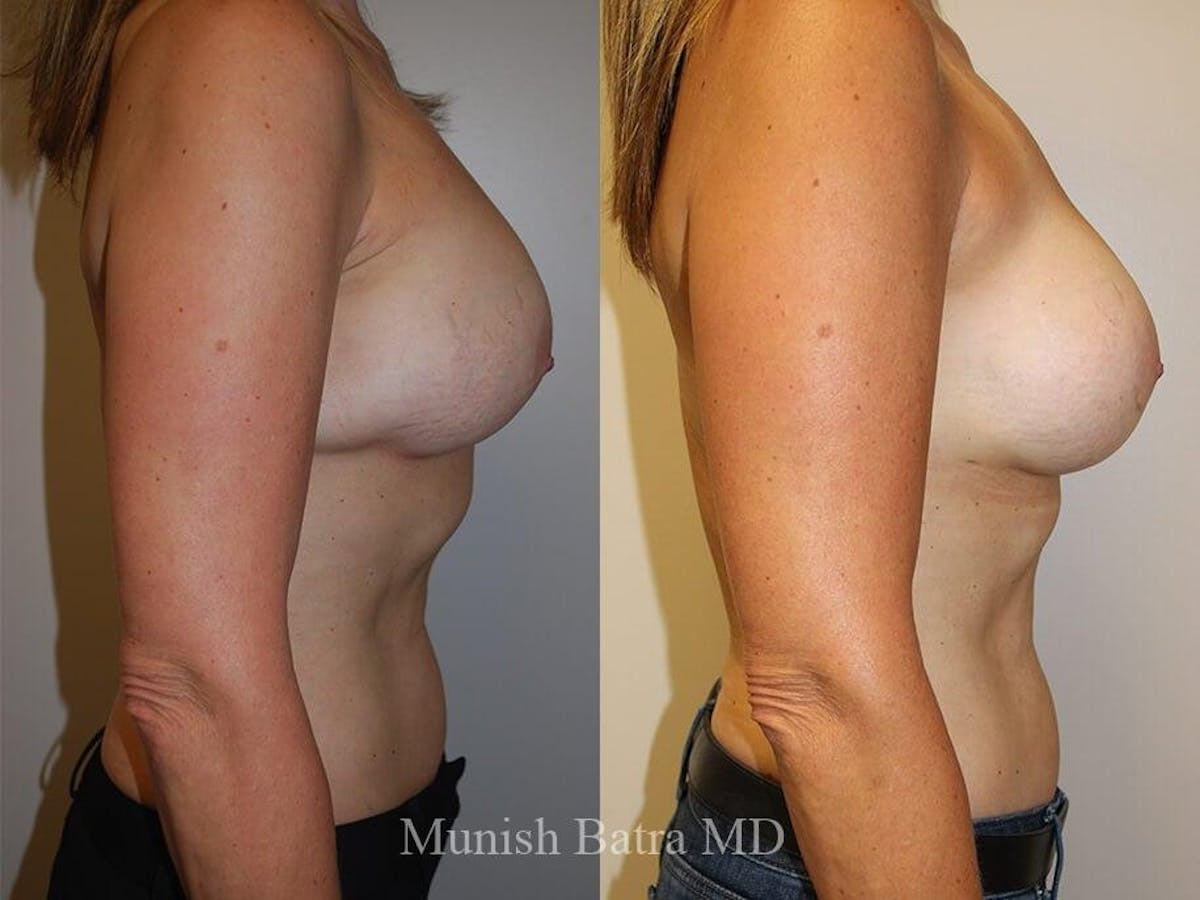 Complex Breast Before & After Gallery - Patient 329985 - Image 2