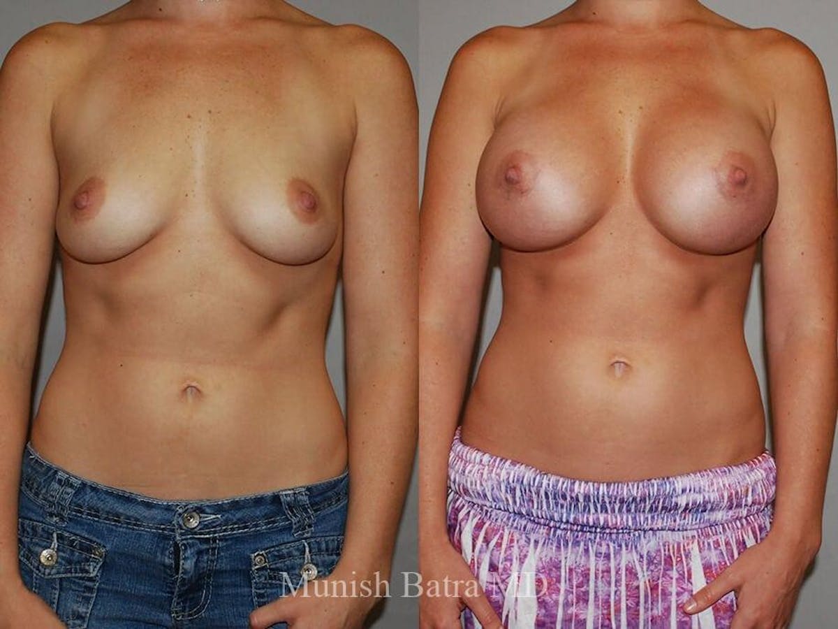 Complex Breast Before & After Gallery - Patient 618561 - Image 1