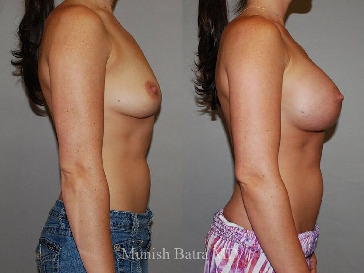 Complex Breast Before & After Gallery - Patient 618561 - Image 2