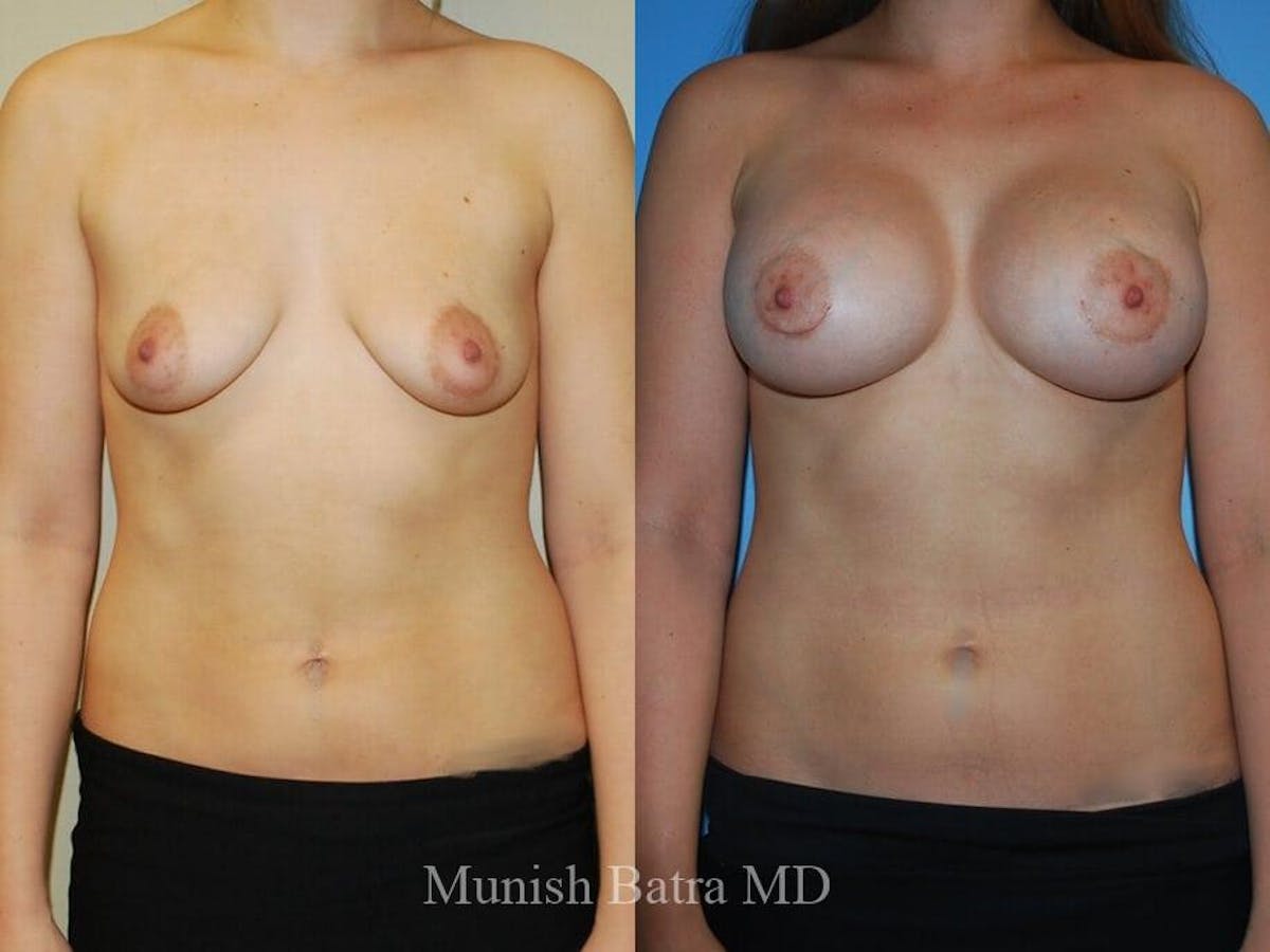 Complex Breast Before & After Gallery - Patient 186398 - Image 1