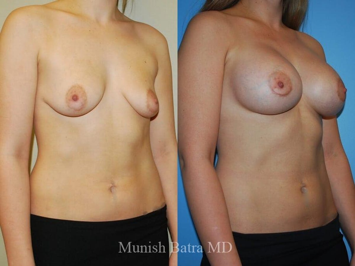 Complex Breast Before & After Gallery - Patient 186398 - Image 2