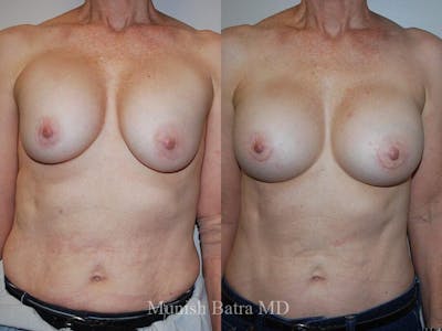 Complex Breast Before & After Gallery - Patient 353643 - Image 1