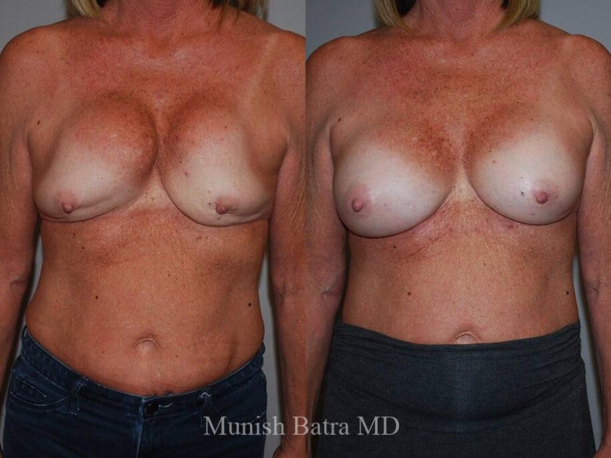 Complex Breast Before & After Gallery - Patient 304851 - Image 1