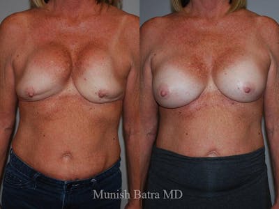 Complex Breast Before & After Gallery - Patient 304851 - Image 1
