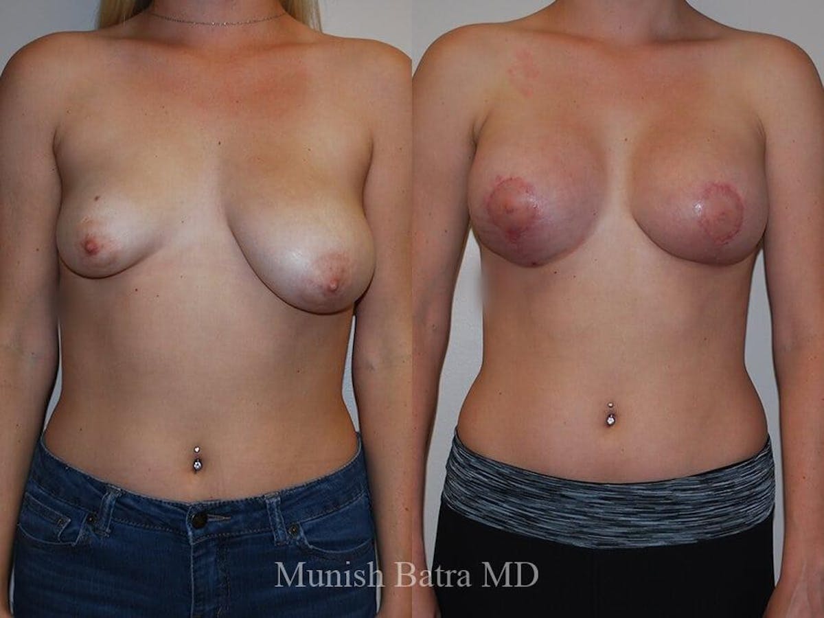 Complex Breast Before & After Gallery - Patient 140301 - Image 1