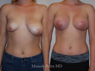 Complex Breast Before & After Gallery - Patient 140301 - Image 1