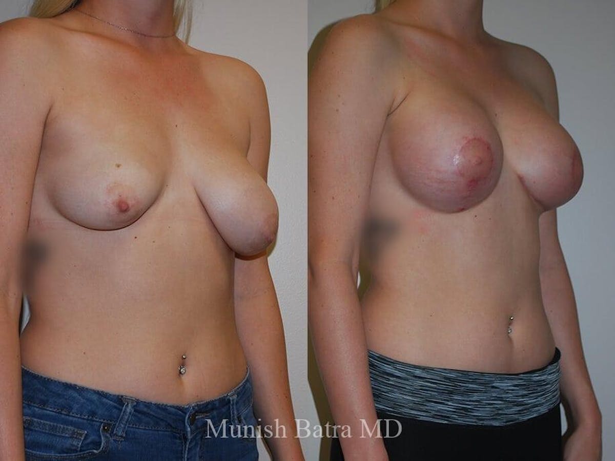 Complex Breast Before & After Gallery - Patient 140301 - Image 2