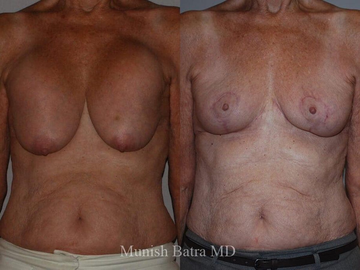 Complex Breast Before & After Gallery - Patient 377202 - Image 1