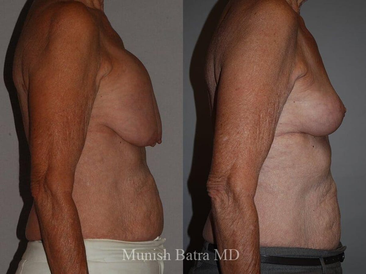 Complex Breast Before & After Gallery - Patient 377202 - Image 2