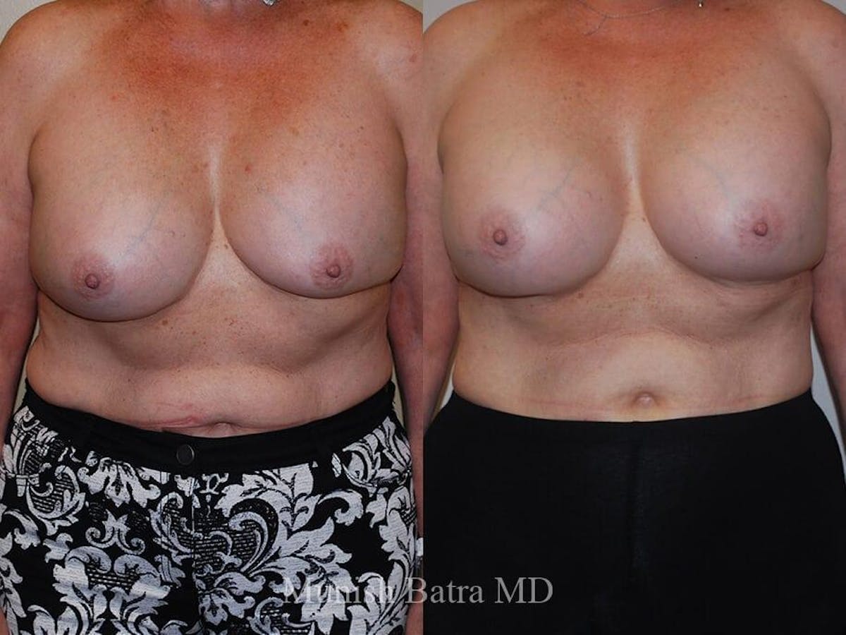 Complex Breast Before & After Gallery - Patient 639980 - Image 1