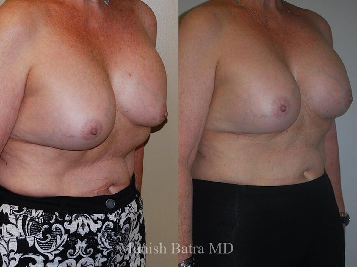 Complex Breast Before & After Gallery - Patient 639980 - Image 2
