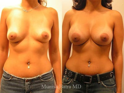 Complex Breast Before & After Gallery - Patient 276990 - Image 1