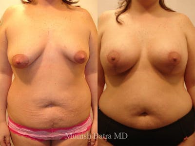 Complex Breast Before & After Gallery - Patient 375409 - Image 1