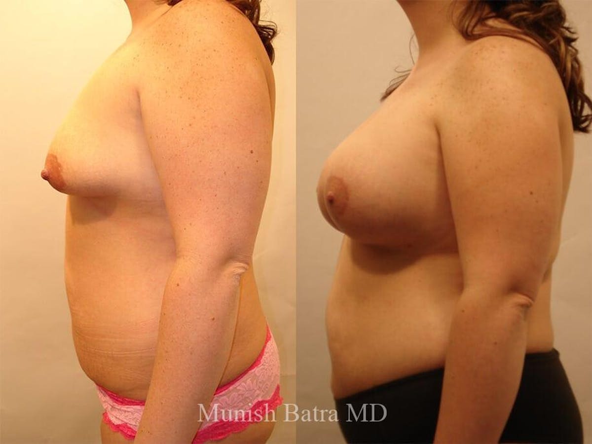 Complex Breast Before & After Gallery - Patient 375409 - Image 2