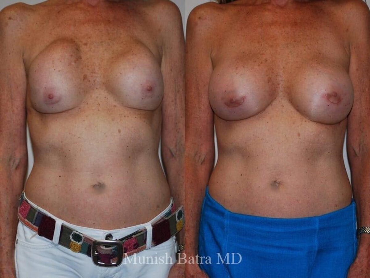 Complex Breast Before & After Gallery - Patient 109904 - Image 1