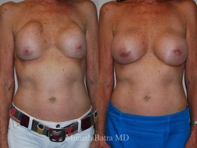 Complex Breast Before & After Gallery - Patient 109904 - Image 1