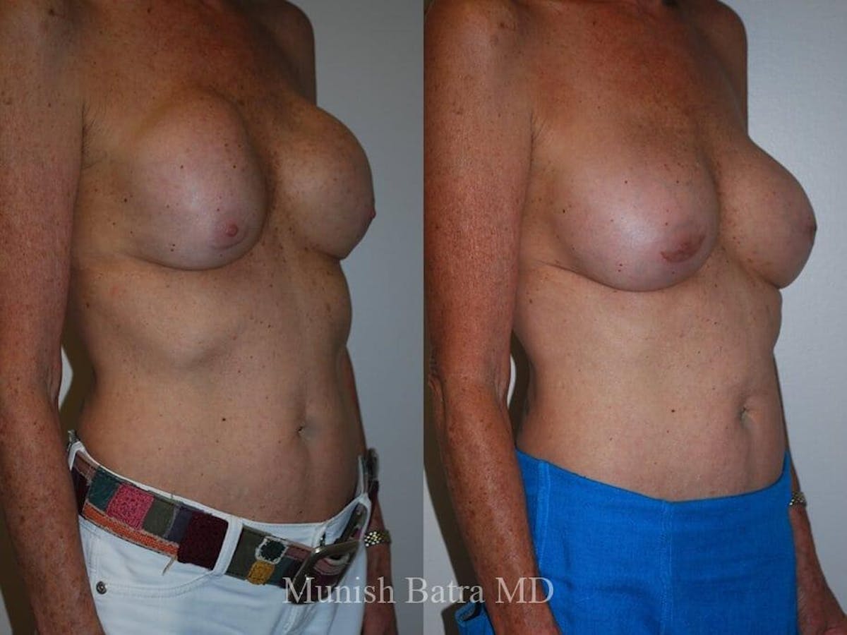Complex Breast Before & After Gallery - Patient 109904 - Image 2