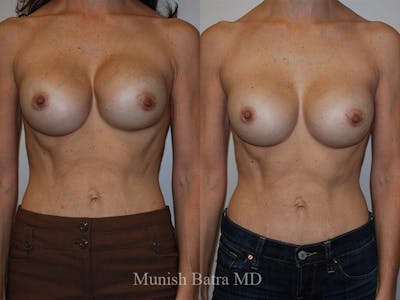 Complex Breast Before & After Gallery - Patient 174881 - Image 1