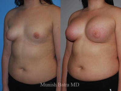 Complex Breast Before & After Gallery - Patient 404710 - Image 1