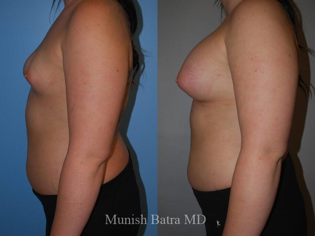 Complex Breast Before & After Gallery - Patient 404710 - Image 2