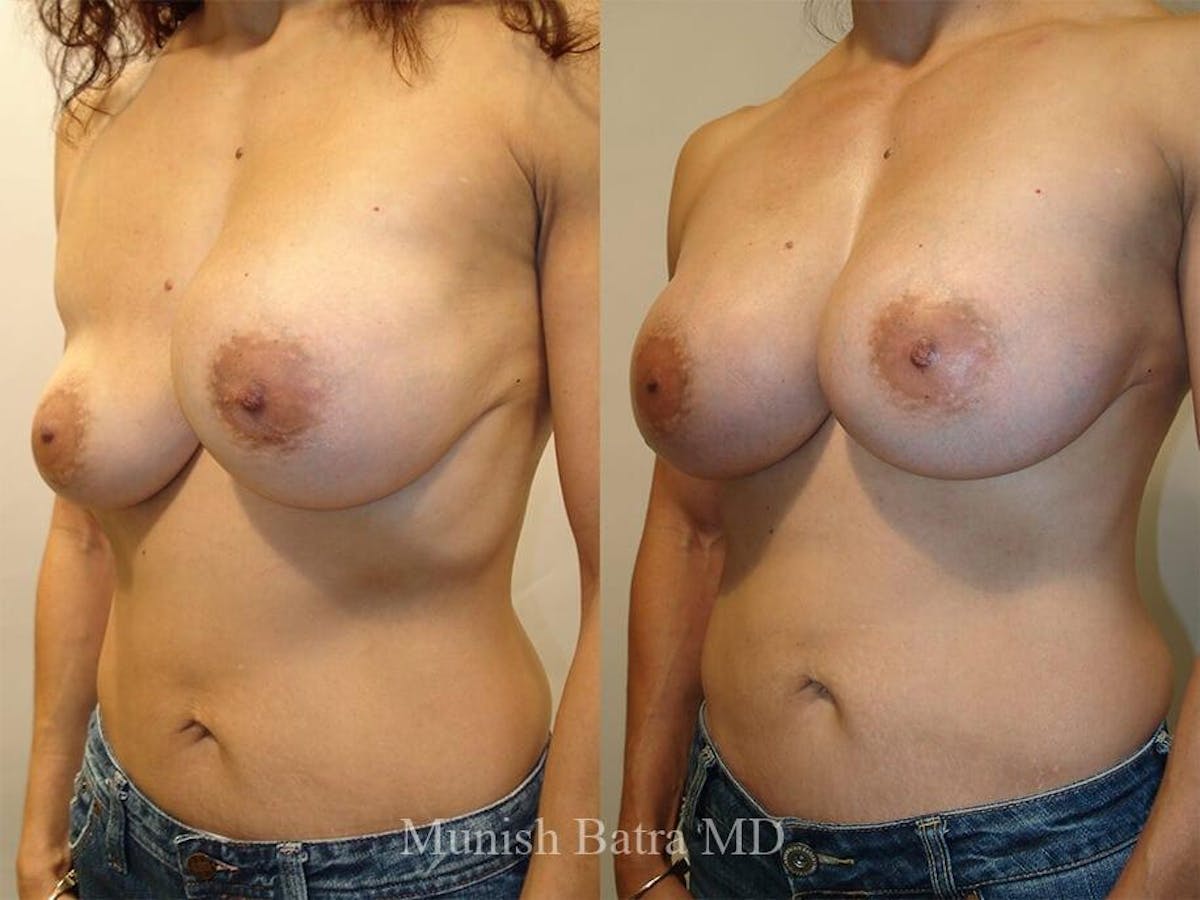Complex Breast Before & After Gallery - Patient 144027 - Image 1