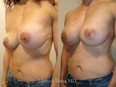 Complex Breast Before & After Gallery - Patient 144027 - Image 1
