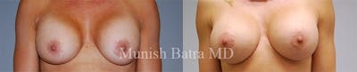 Complex Breast Before & After Gallery - Patient 221047 - Image 1