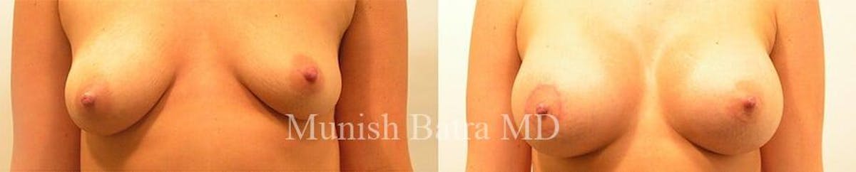 Complex Breast Before & After Gallery - Patient 163937 - Image 1