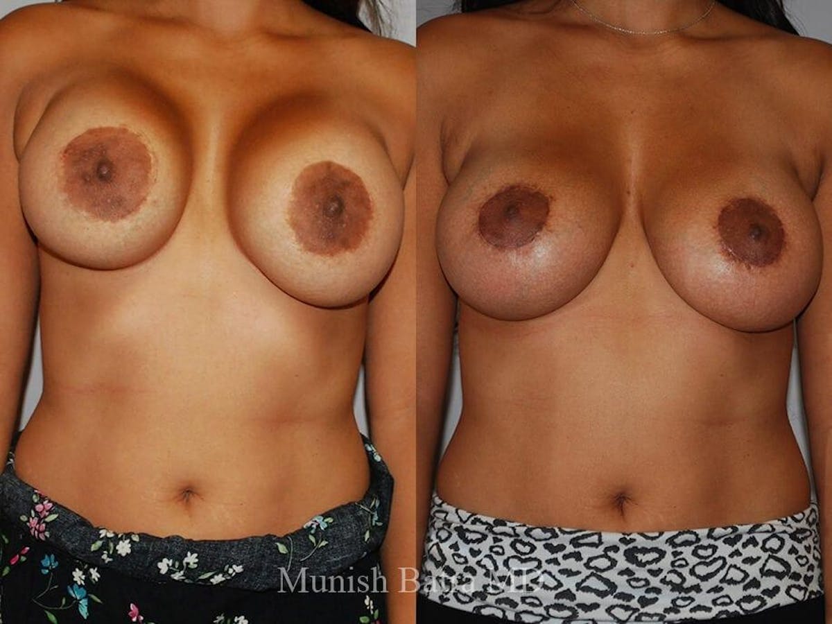 Complex Breast Before & After Gallery - Patient 414076 - Image 1