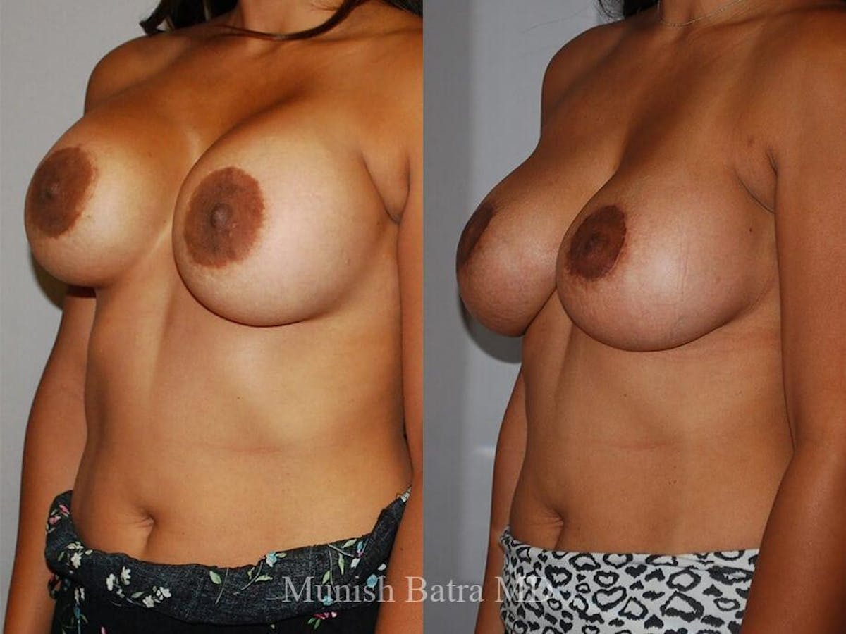 Complex Breast Before & After Gallery - Patient 414076 - Image 2