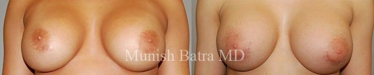 Complex Breast Before & After Gallery - Patient 421819 - Image 1