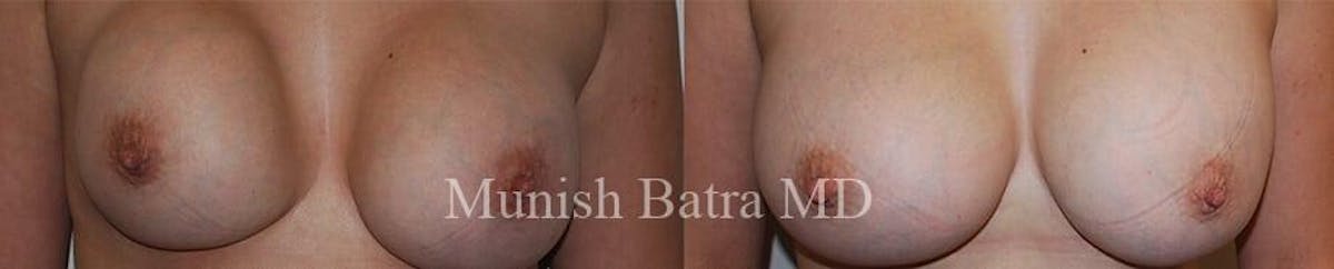 Complex Breast Before & After Gallery - Patient 287867 - Image 1