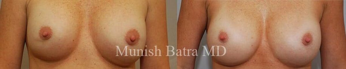 Complex Breast Before & After Gallery - Patient 404942 - Image 1