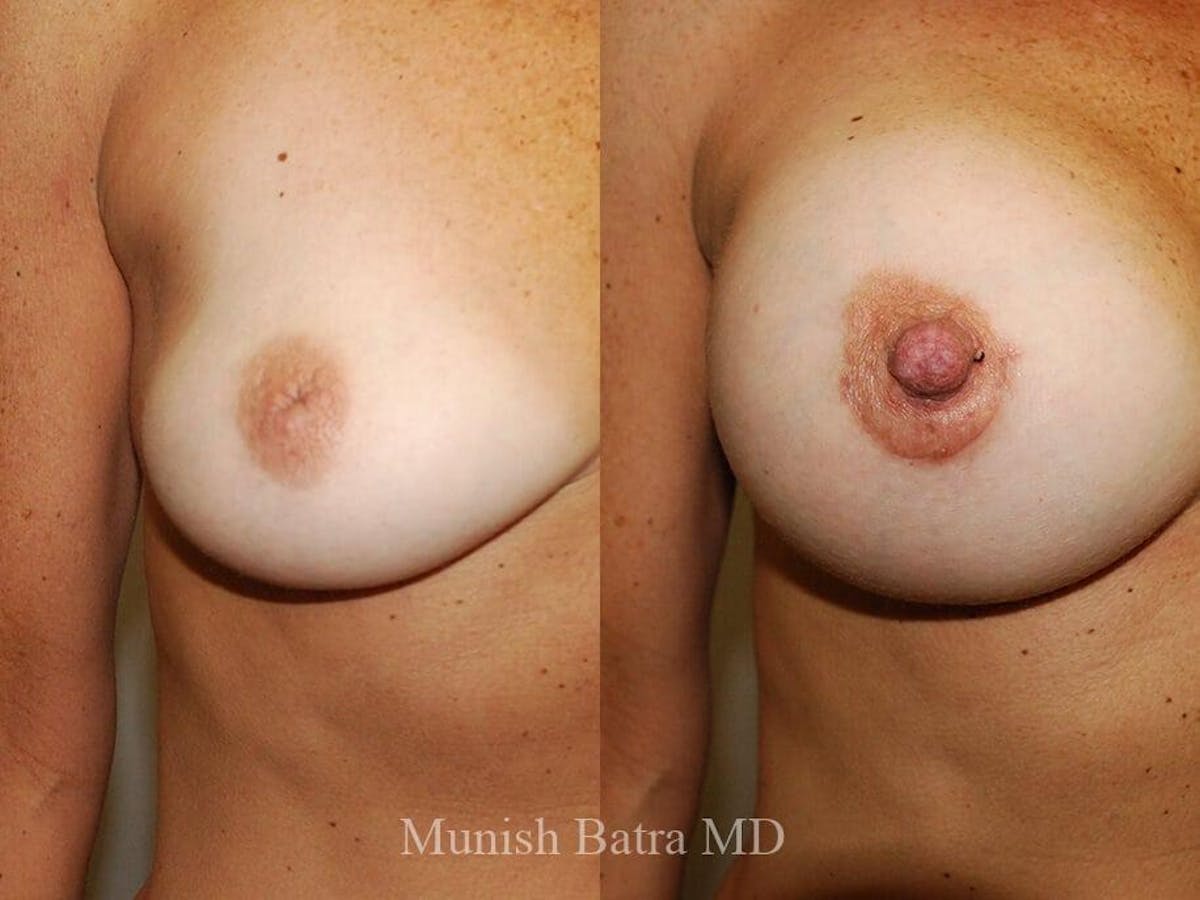 Complex Breast Before & After Gallery - Patient 474474 - Image 1