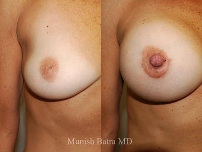 Complex Breast Before & After Gallery - Patient 474474 - Image 1