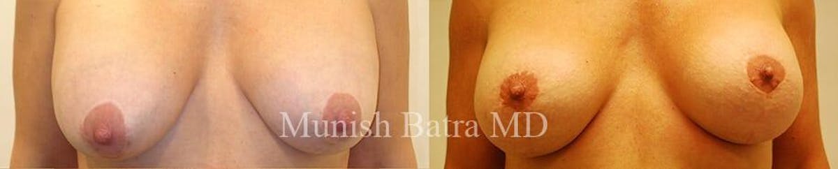 Complex Breast Before & After Gallery - Patient 104167 - Image 1