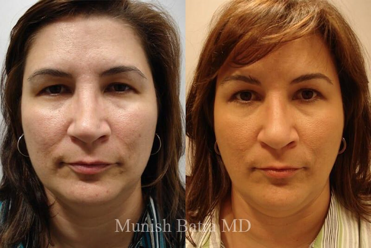 Eyelid Surgery and Brow Lift Before & After Gallery - Patient 399817 - Image 1