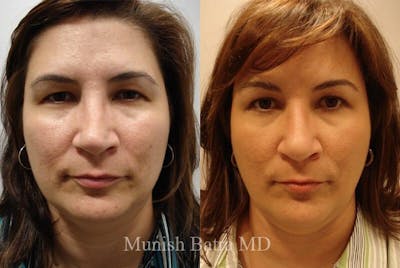 Eyelid Surgery and Brow Lift Before & After Gallery - Patient 399817 - Image 1