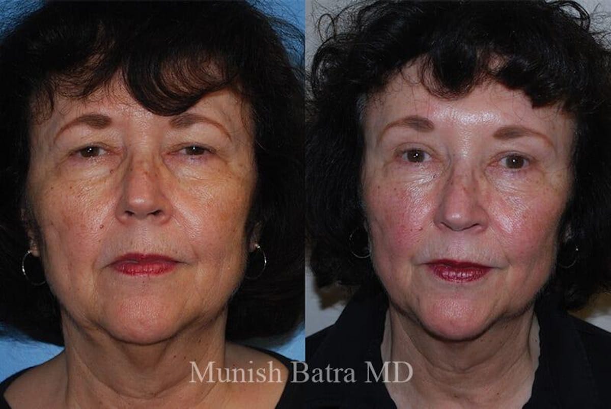 Eyelid Surgery and Brow Lift Before & After Gallery - Patient 373164 - Image 1