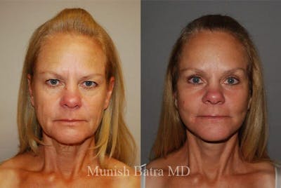 Eyelid Surgery and Brow Lift Before & After Gallery - Patient 762274 - Image 1