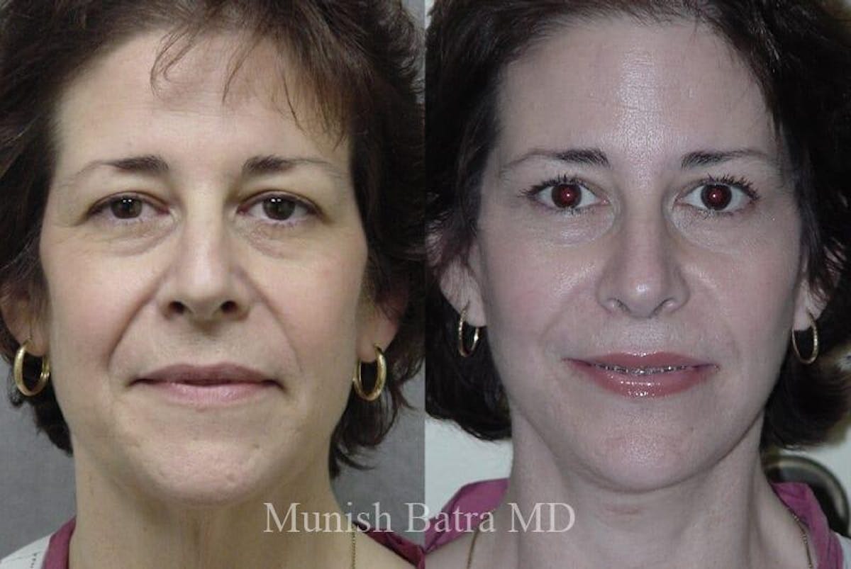 Eyelid Surgery and Brow Lift Before & After Gallery - Patient 137830 - Image 1
