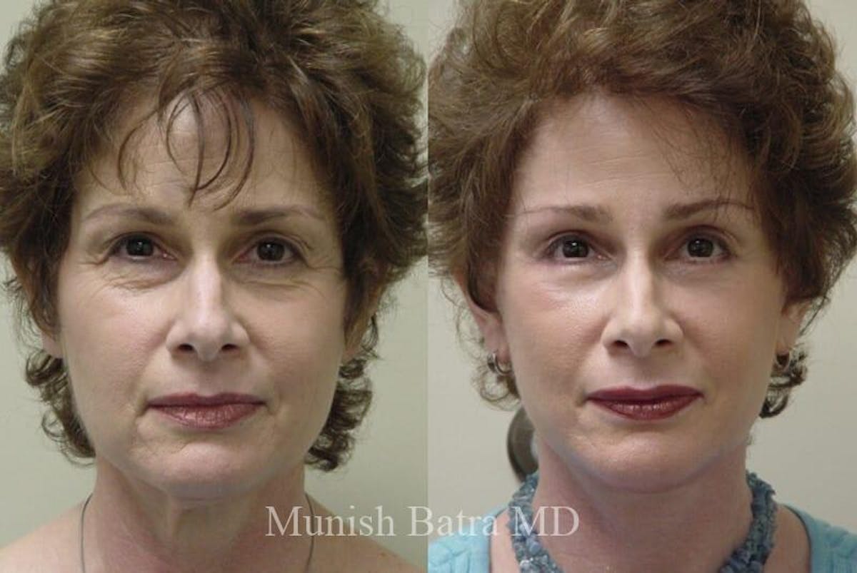 Eyelid Surgery and Brow Lift Before & After Gallery - Patient 216970 - Image 1