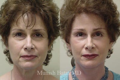 Eyelid Surgery and Brow Lift Before & After Gallery - Patient 216970 - Image 1
