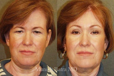 Eyelid Surgery and Brow Lift Before & After Gallery - Patient 400555 - Image 1