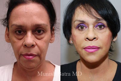 Eyelid Surgery and Brow Lift Before & After Gallery - Patient 119402 - Image 1