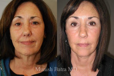 Eyelid Surgery and Brow Lift Before & After Gallery - Patient 391291 - Image 1
