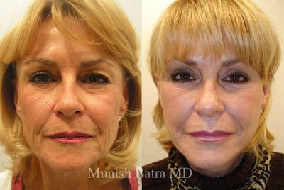 Eyelid Surgery and Brow Lift Before & After Gallery - Patient 665704 - Image 1